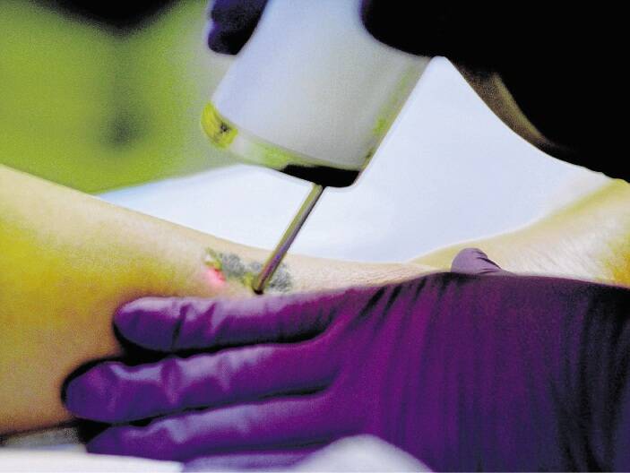 Tattoo removal - Australian Skin Face Body